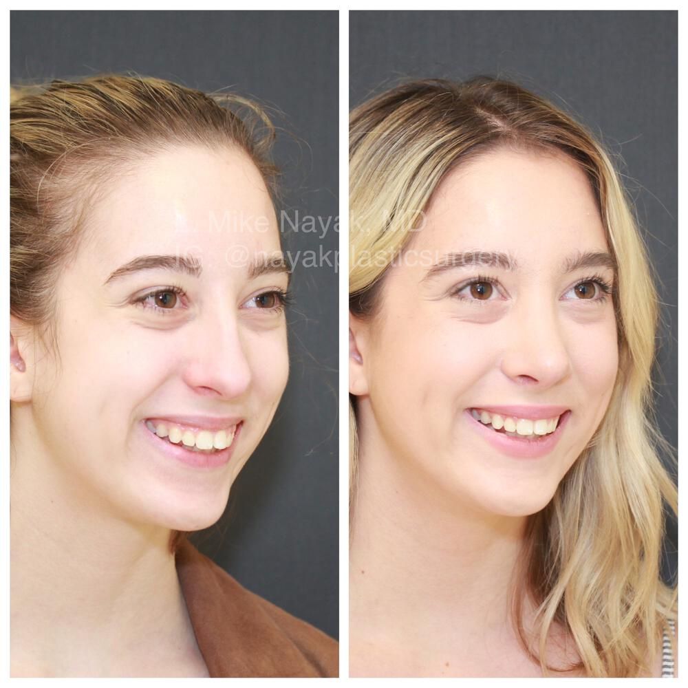 Rhinoplasty Before & After