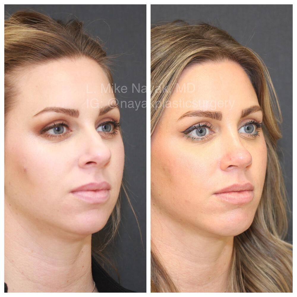 Rhinoplasty Before & After
