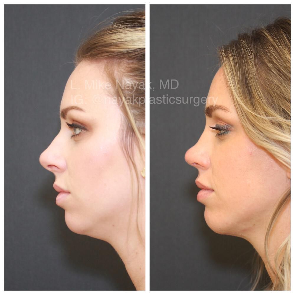 Rhinoplasty Before & After