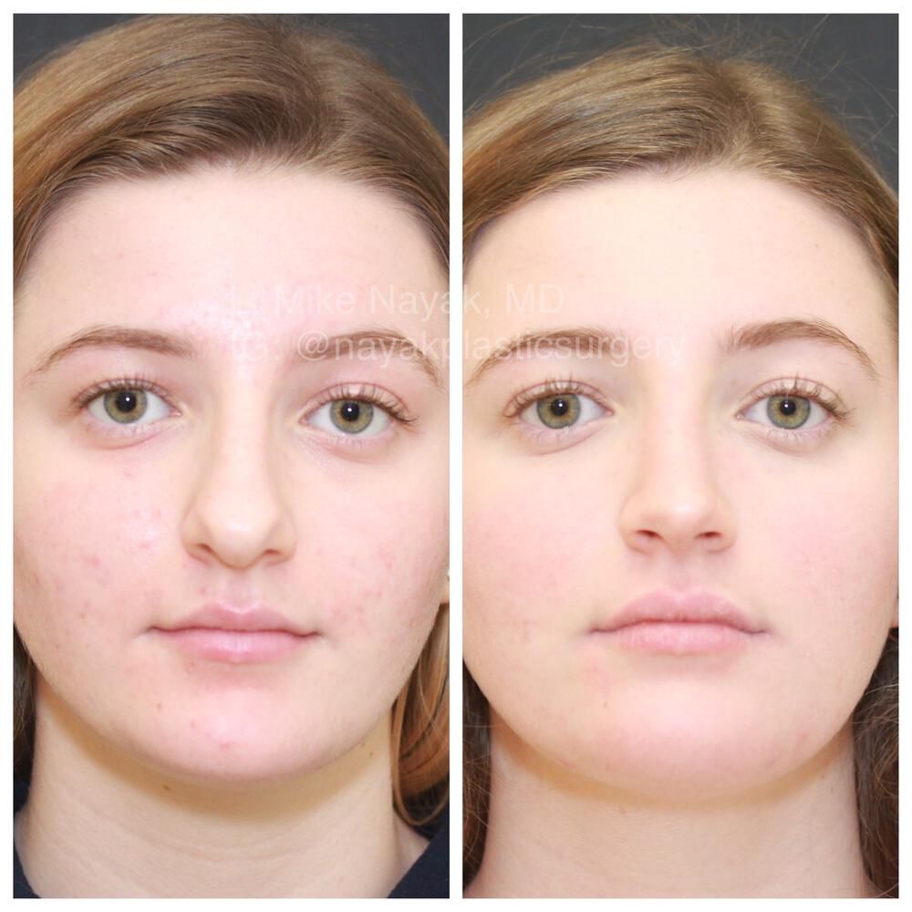 Rhinoplasty Before & After