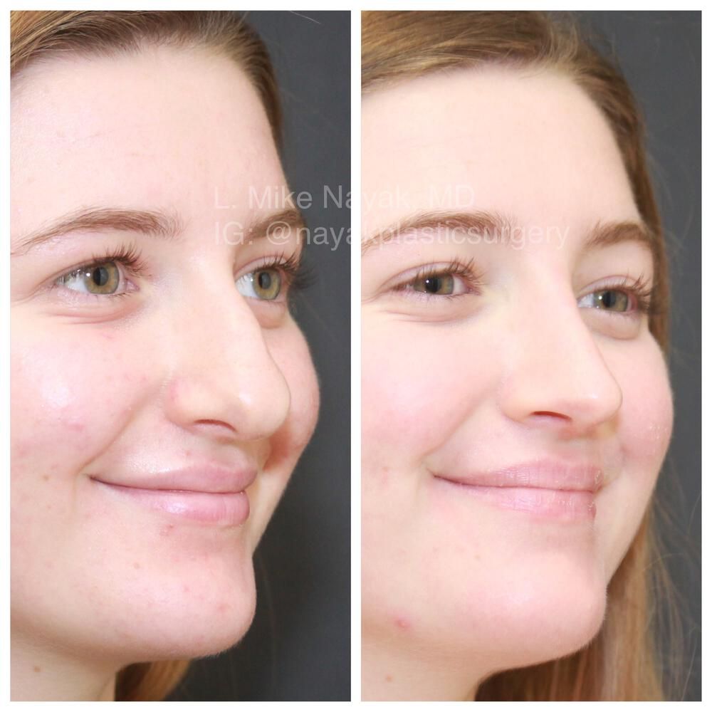 Rhinoplasty Before & After