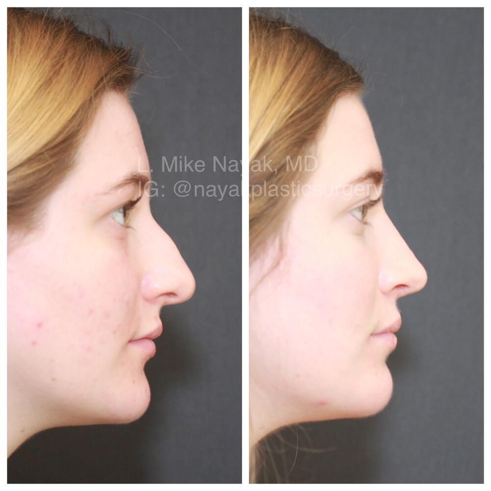 Rhinoplasty Before & After