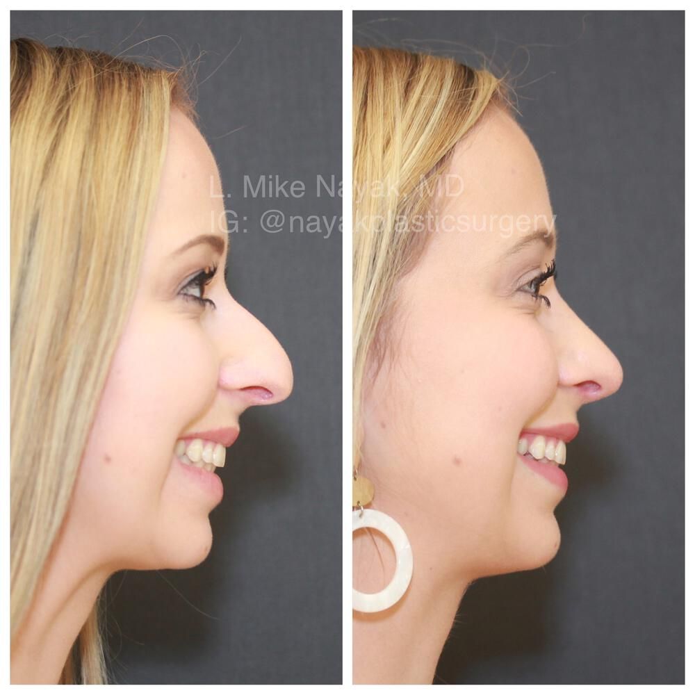 Rhinoplasty Before & After