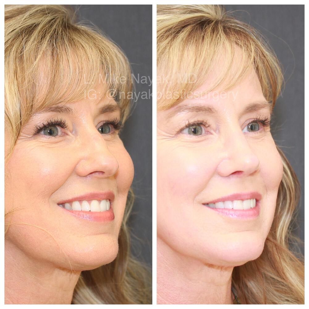 Rhinoplasty Before & After
