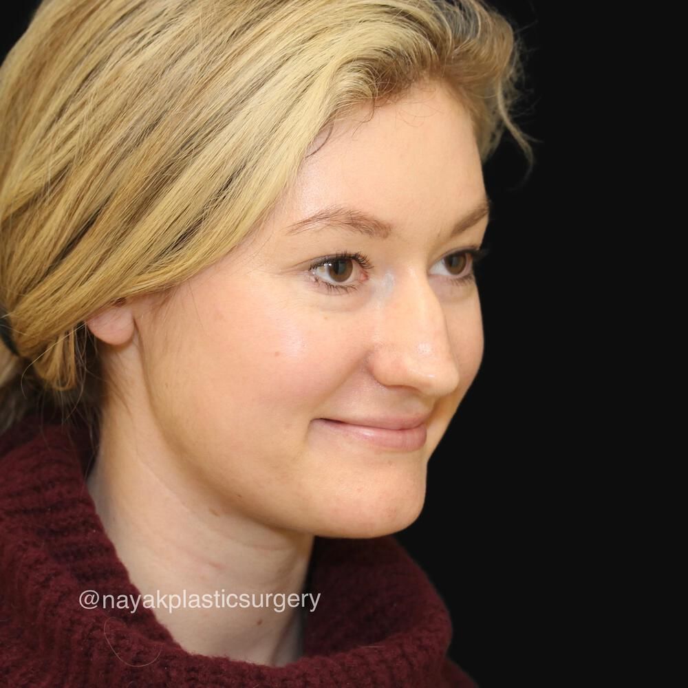 Rhinoplasty Before & After