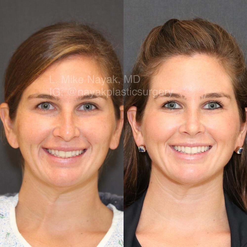 Rhinoplasty Before & After