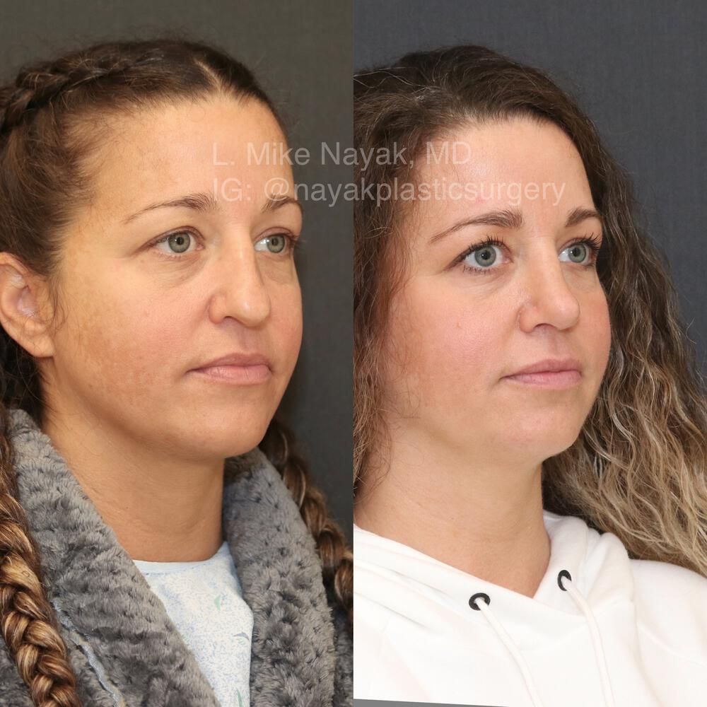 Rhinoplasty Before & After