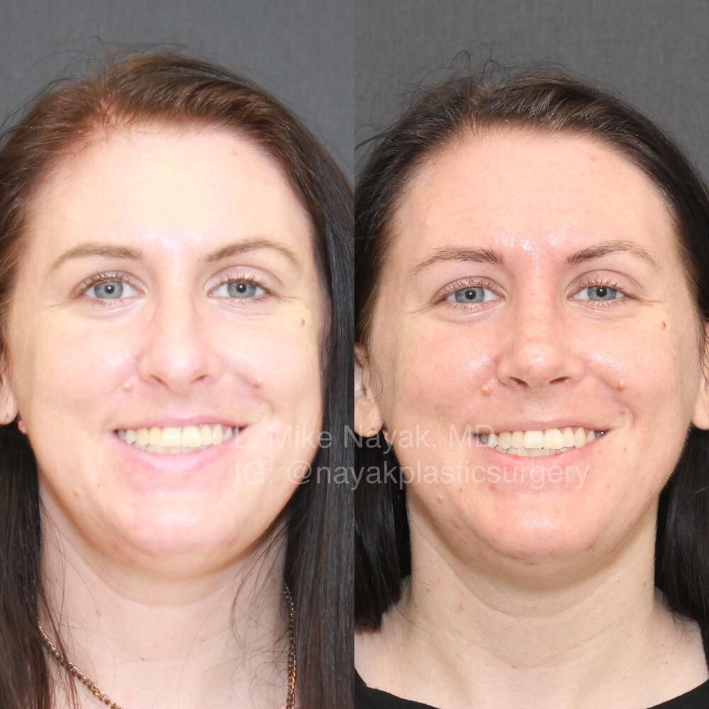 Rhinoplasty Before & After