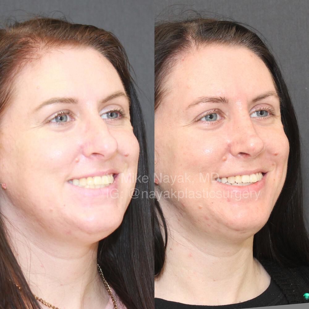 Rhinoplasty Before & After