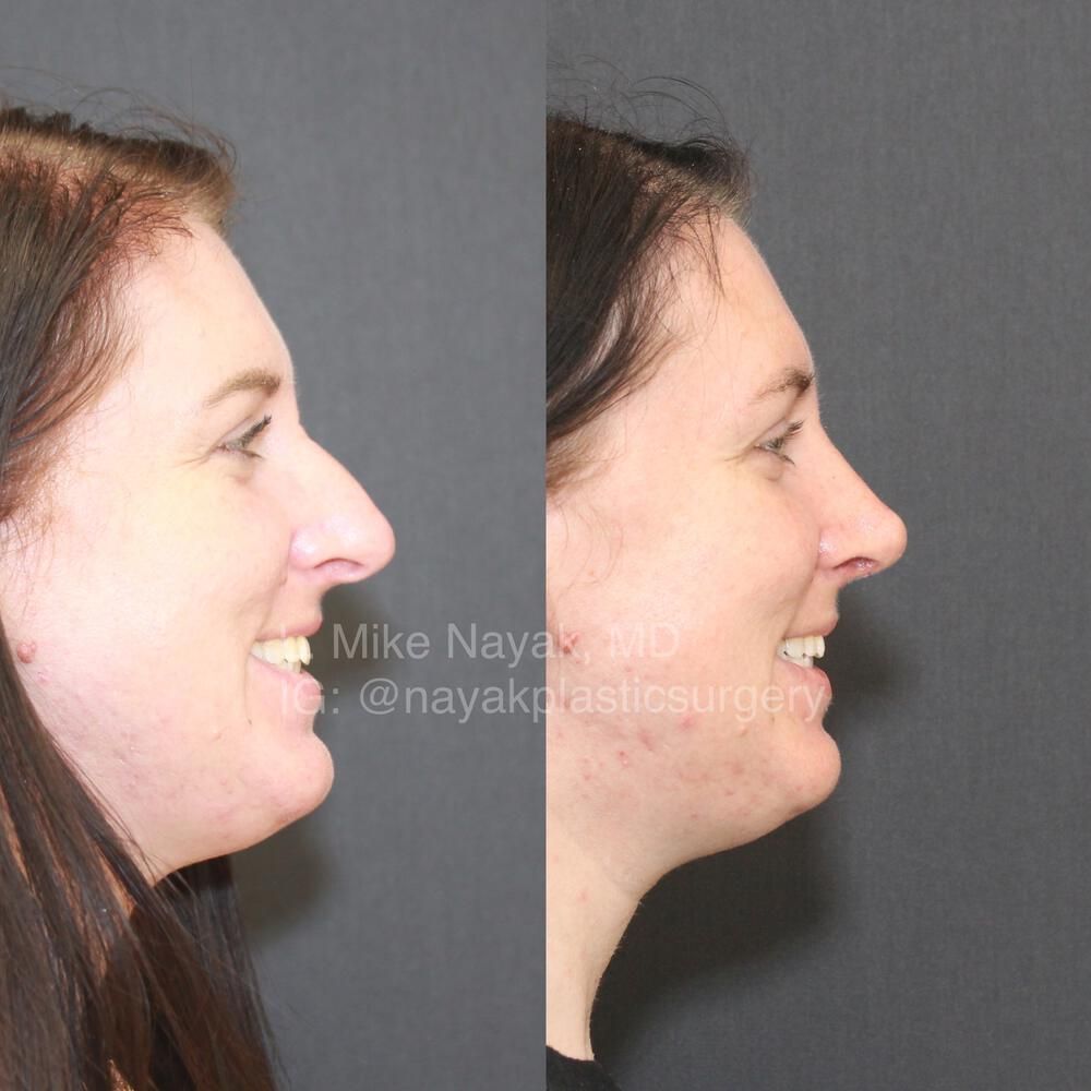 Rhinoplasty Before & After
