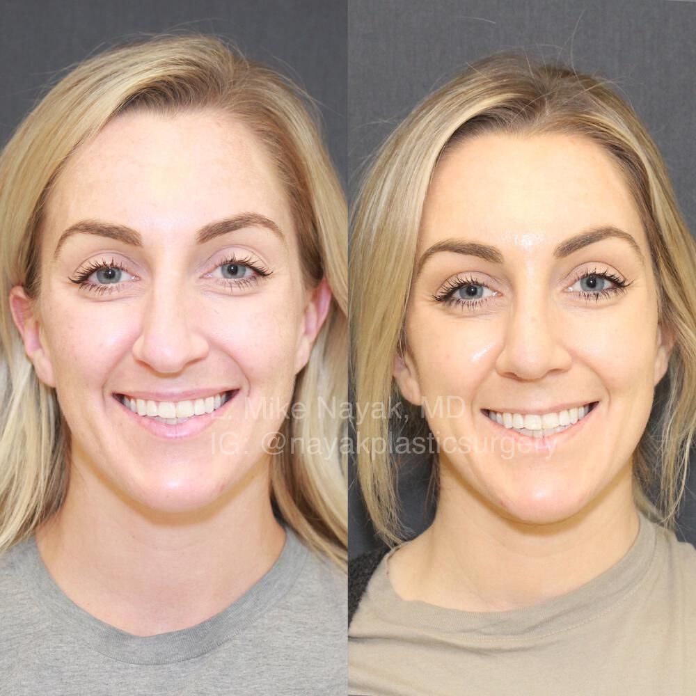 Rhinoplasty Before & After