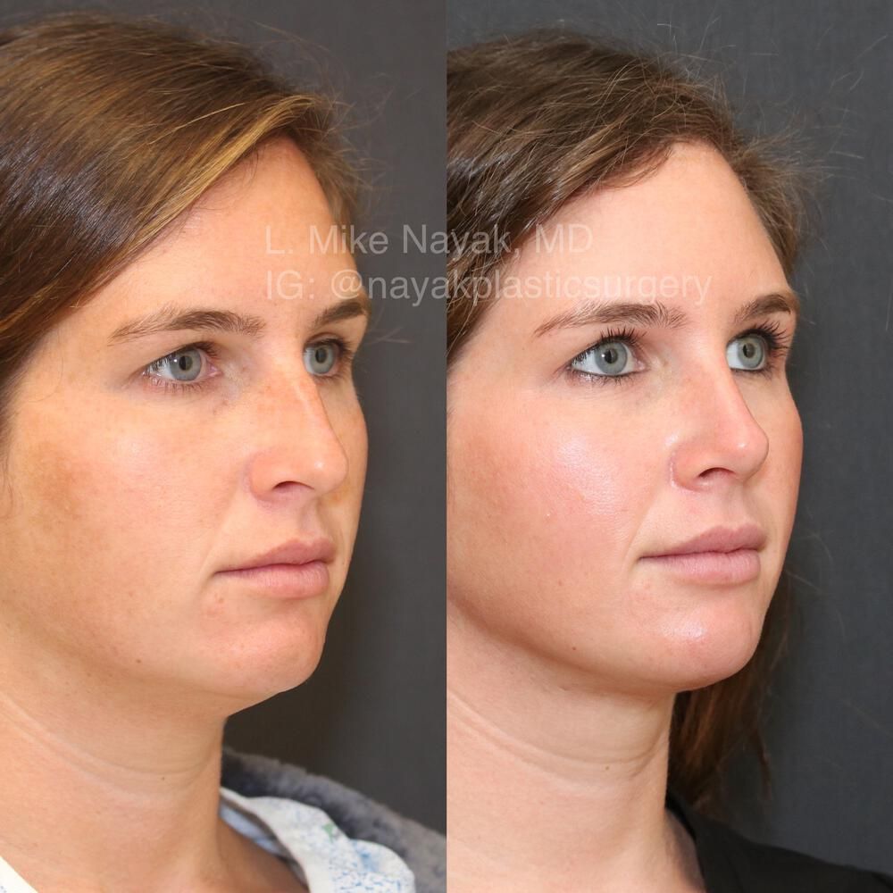 Rhinoplasty Before & After