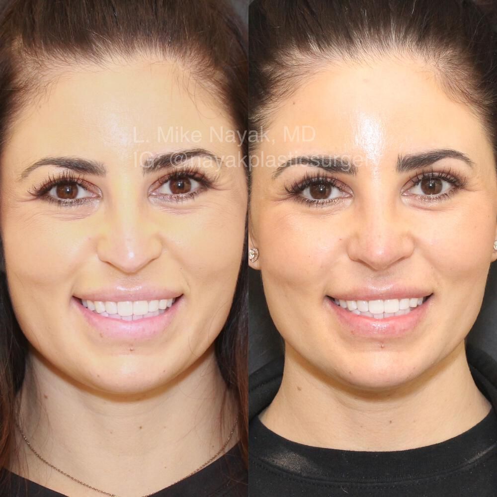 Rhinoplasty Before & After
