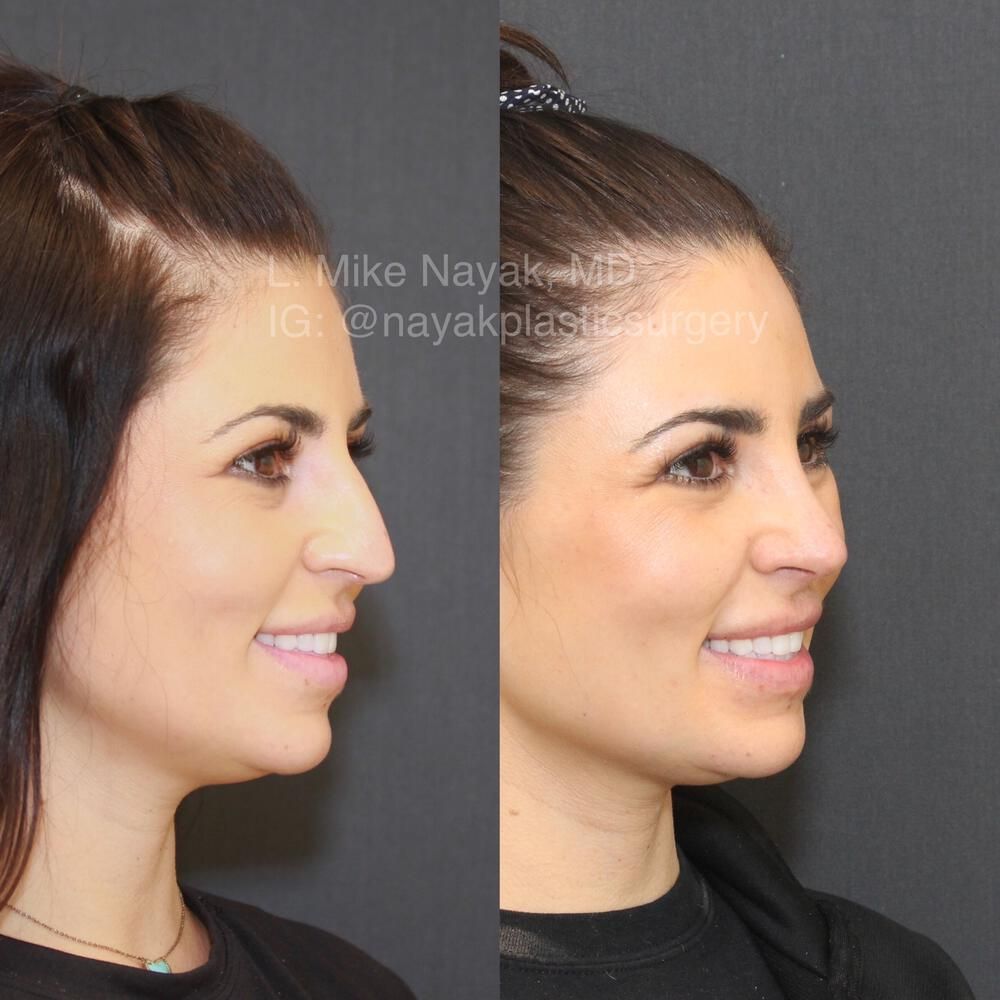 Rhinoplasty Before & After