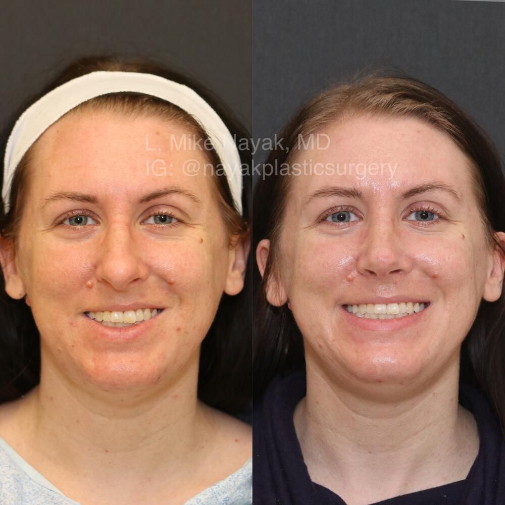 Rhinoplasty Before & After