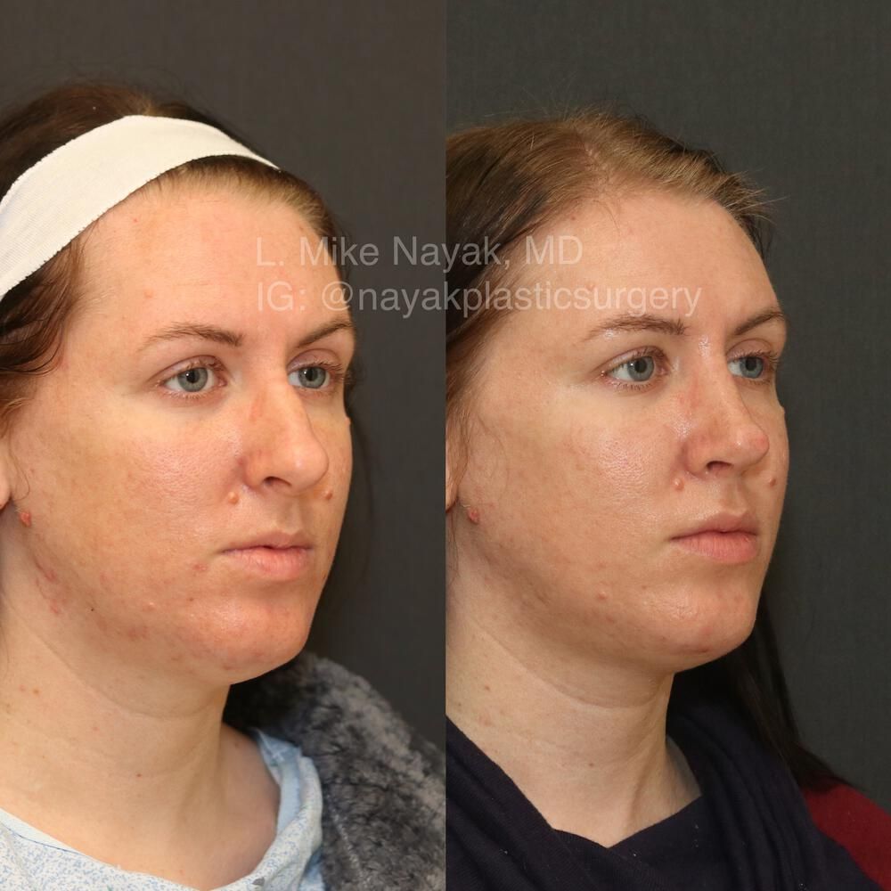 Rhinoplasty Before & After