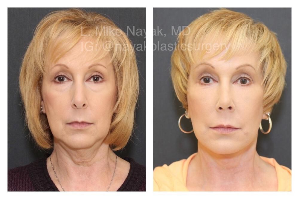 Rhinoplasty Before & After