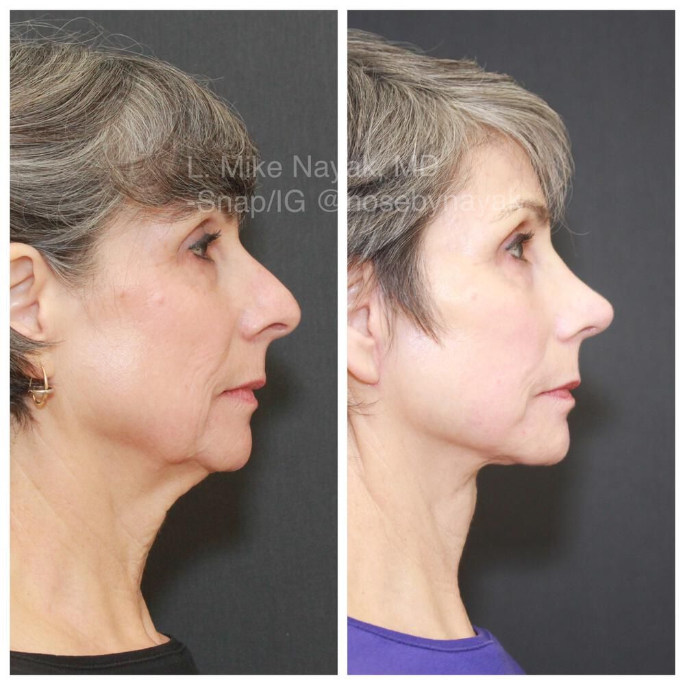 Rhinoplasty Before & After
