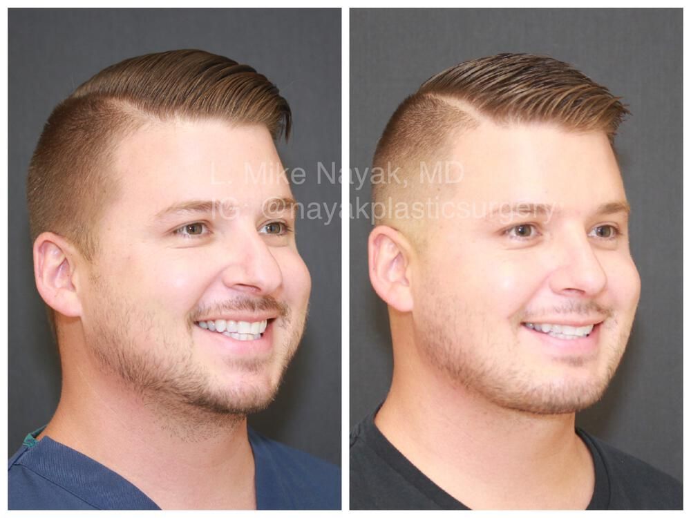 Rhinoplasty Before & After