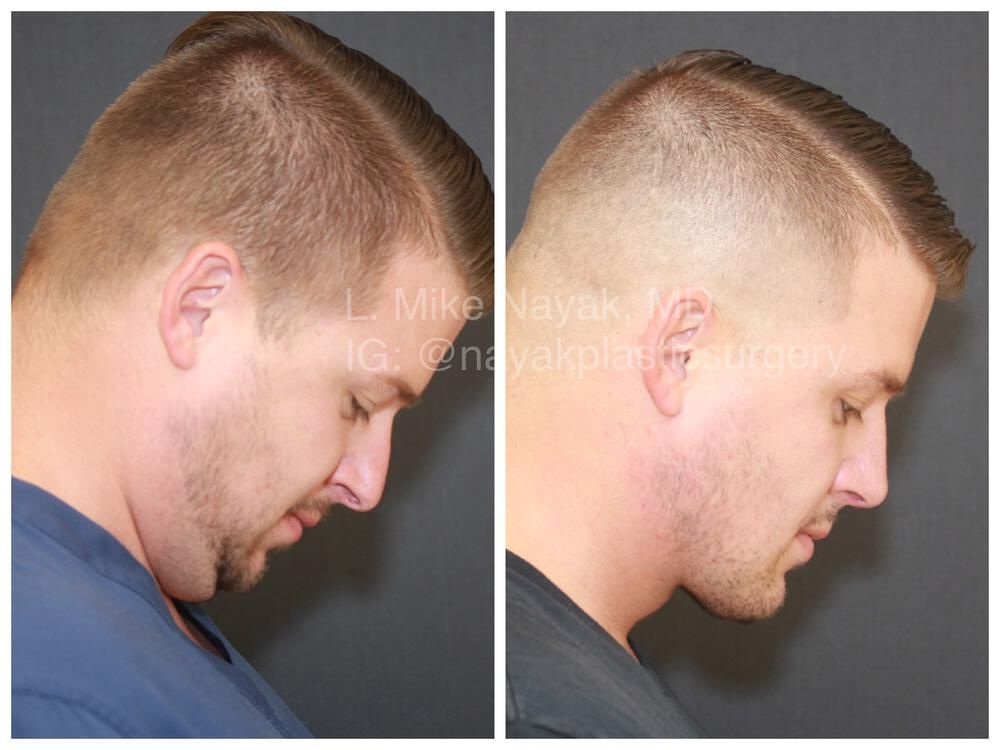 Rhinoplasty Before & After