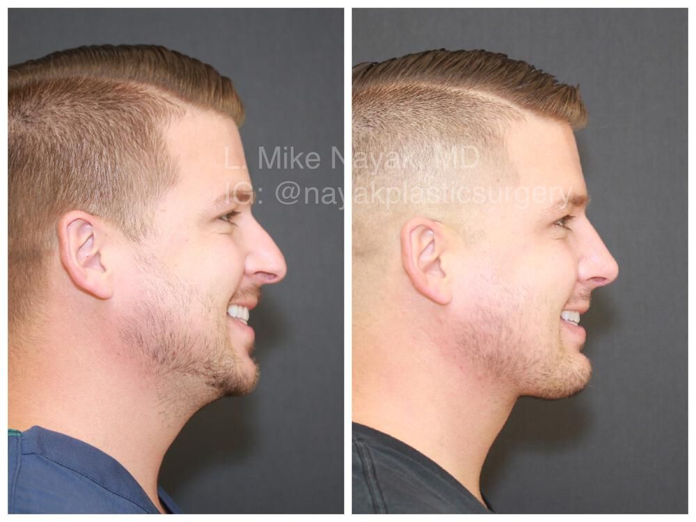 Rhinoplasty Before & After
