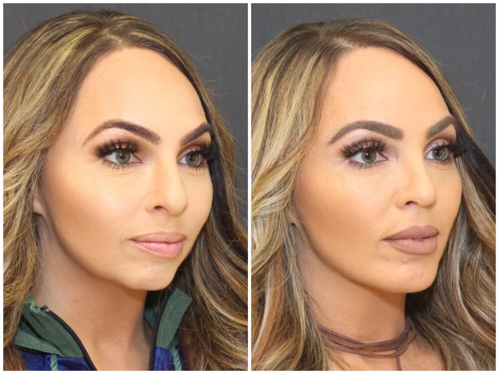 Rhinoplasty Before & After