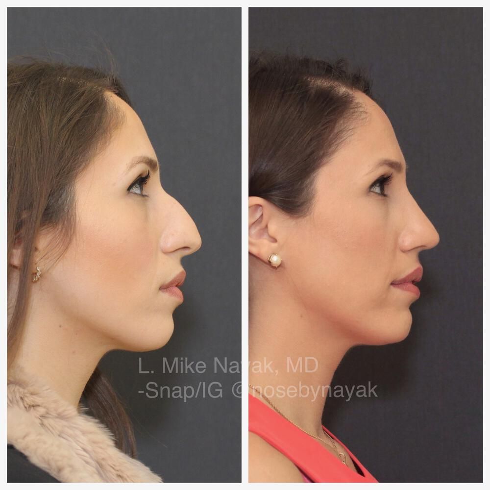 Rhinoplasty Before & After