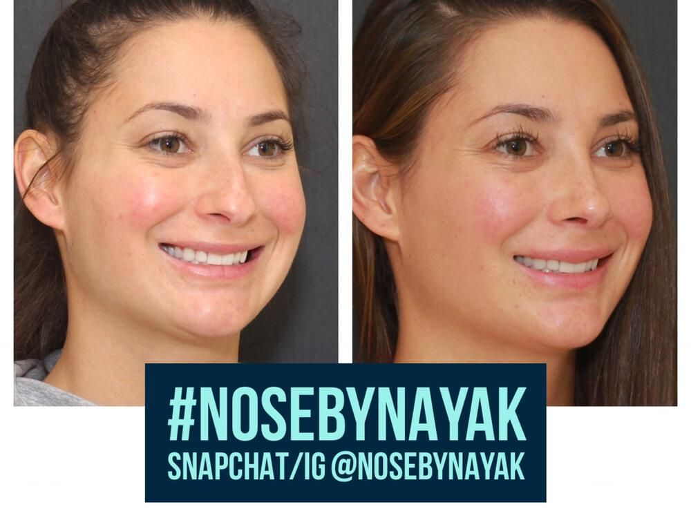 Rhinoplasty Before & After