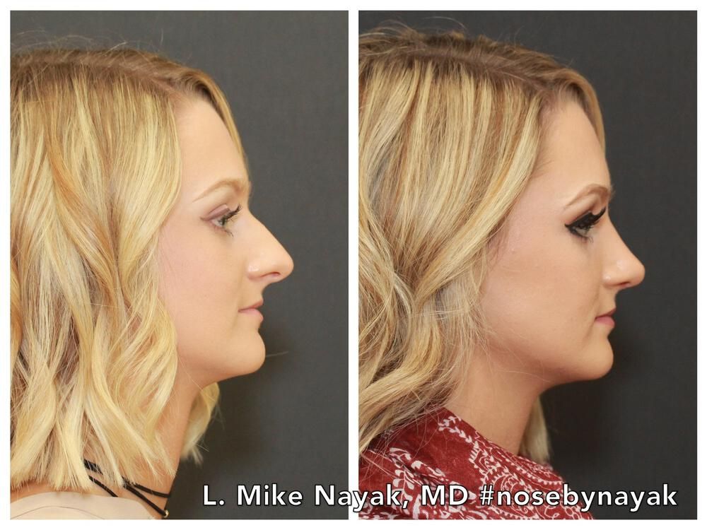 Rhinoplasty Before & After