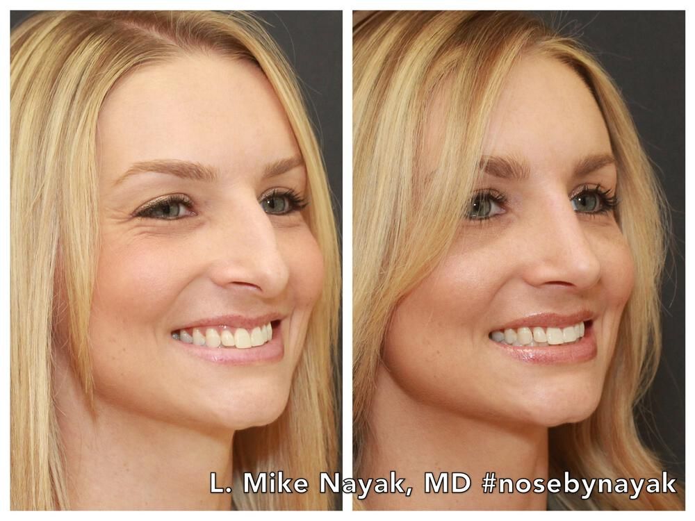 Rhinoplasty Before & After