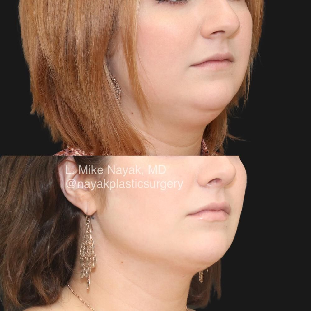 Rhinoplasty Before & After