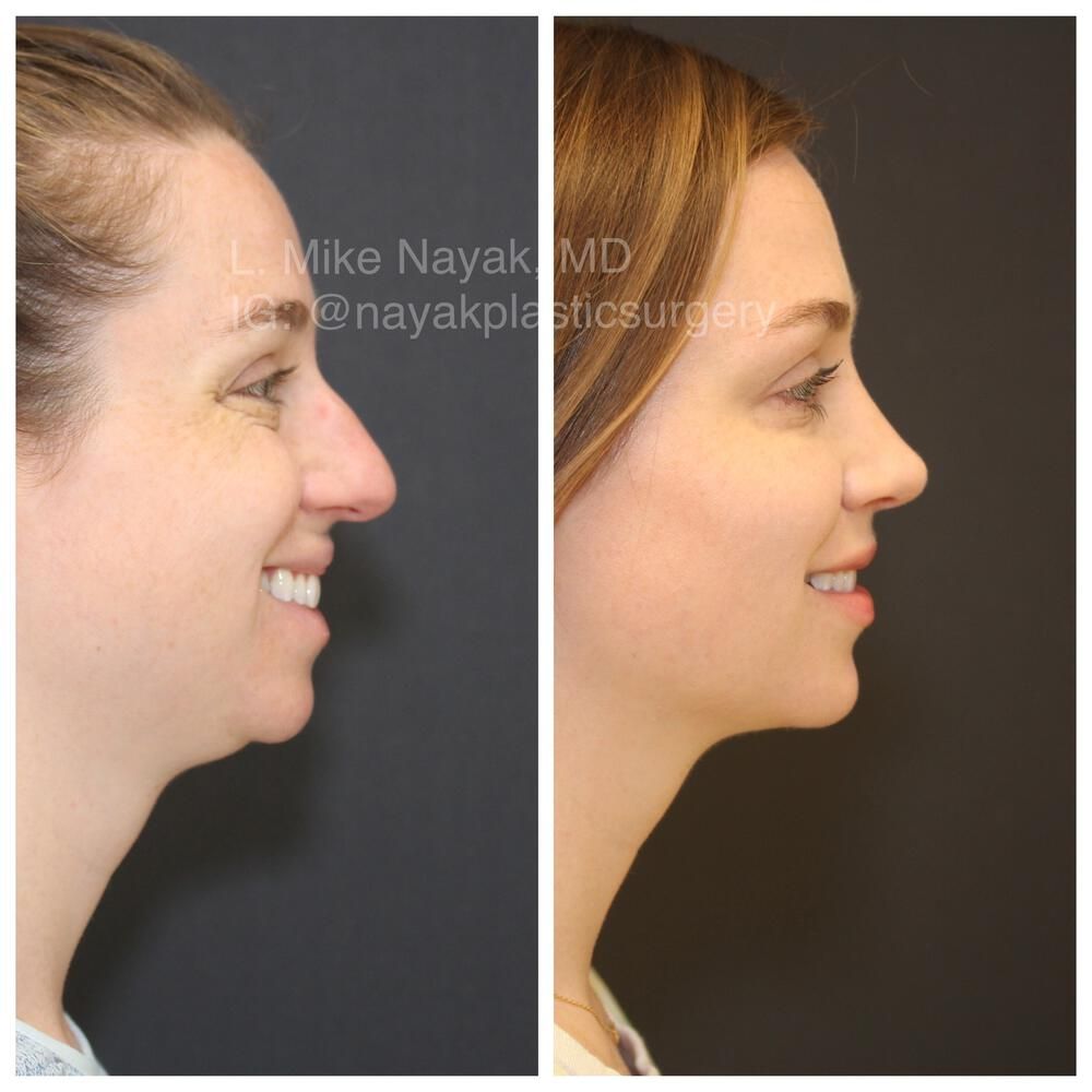 Rhinoplasty Before & After