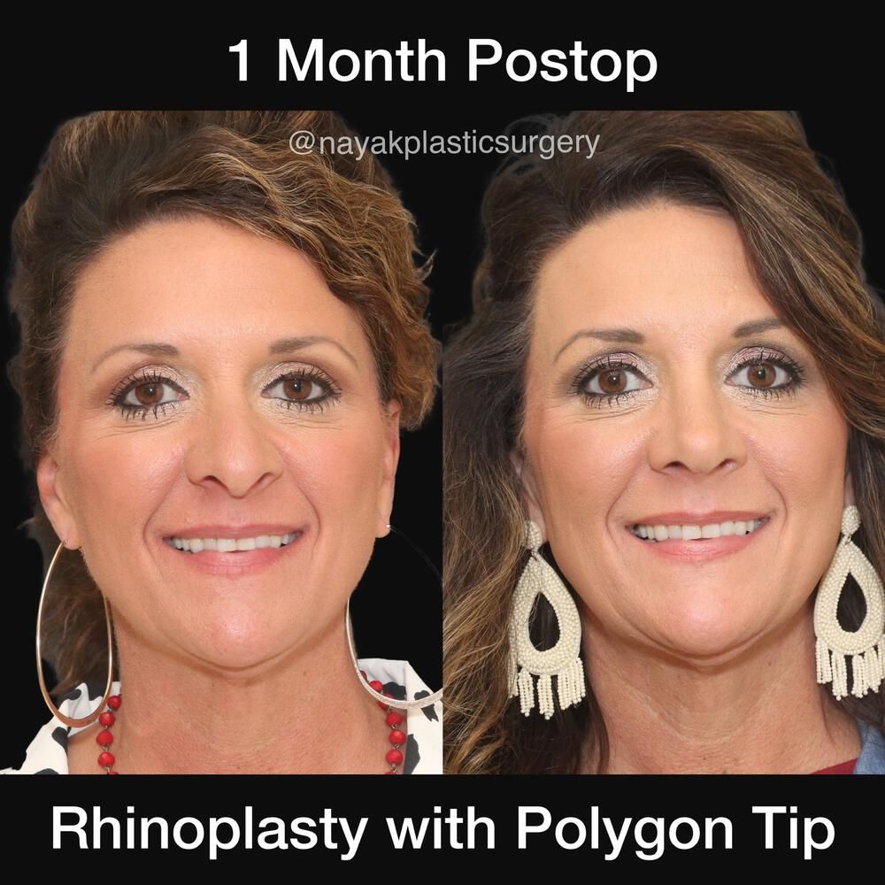 Rhinoplasty Before & After