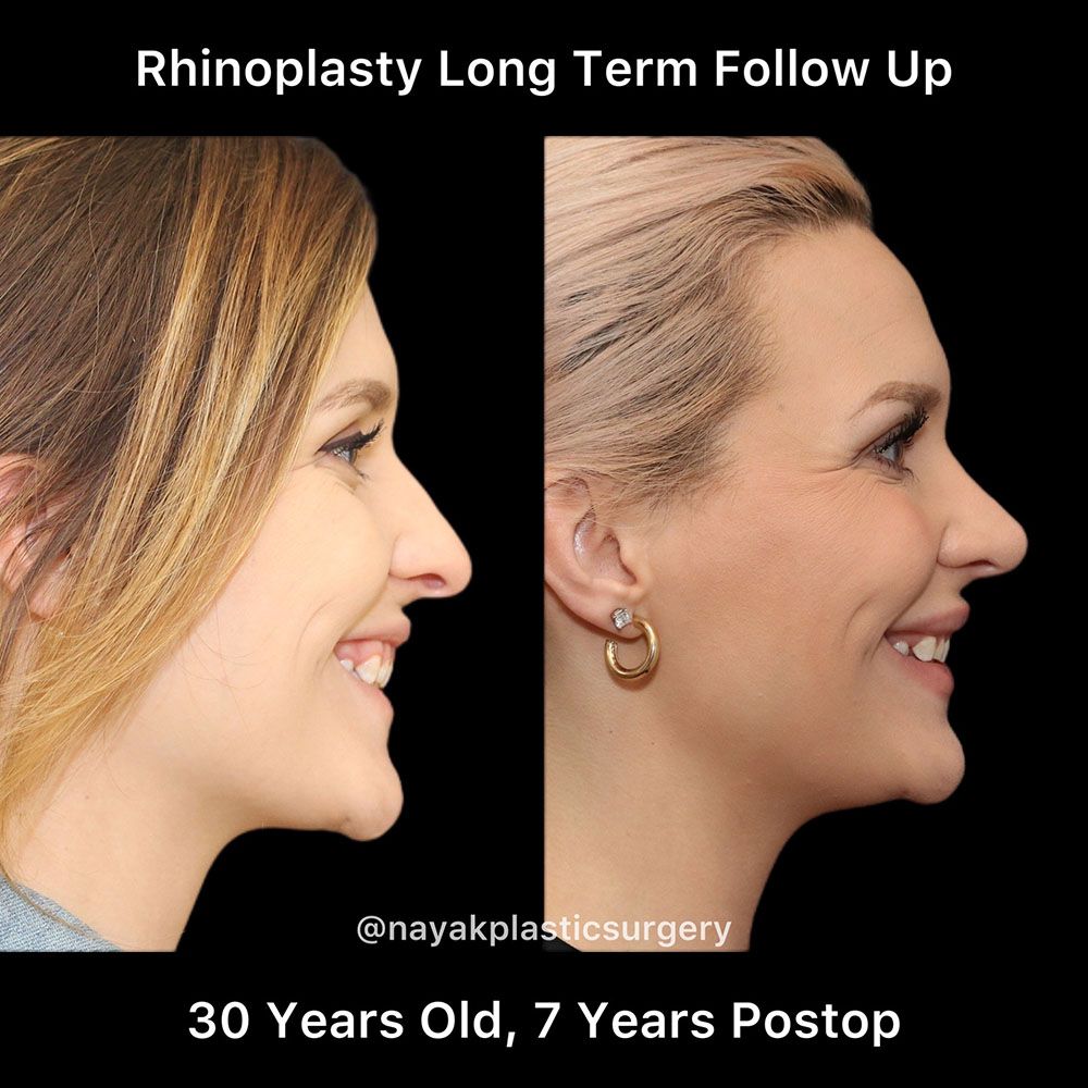 Rhinoplasty Before & After