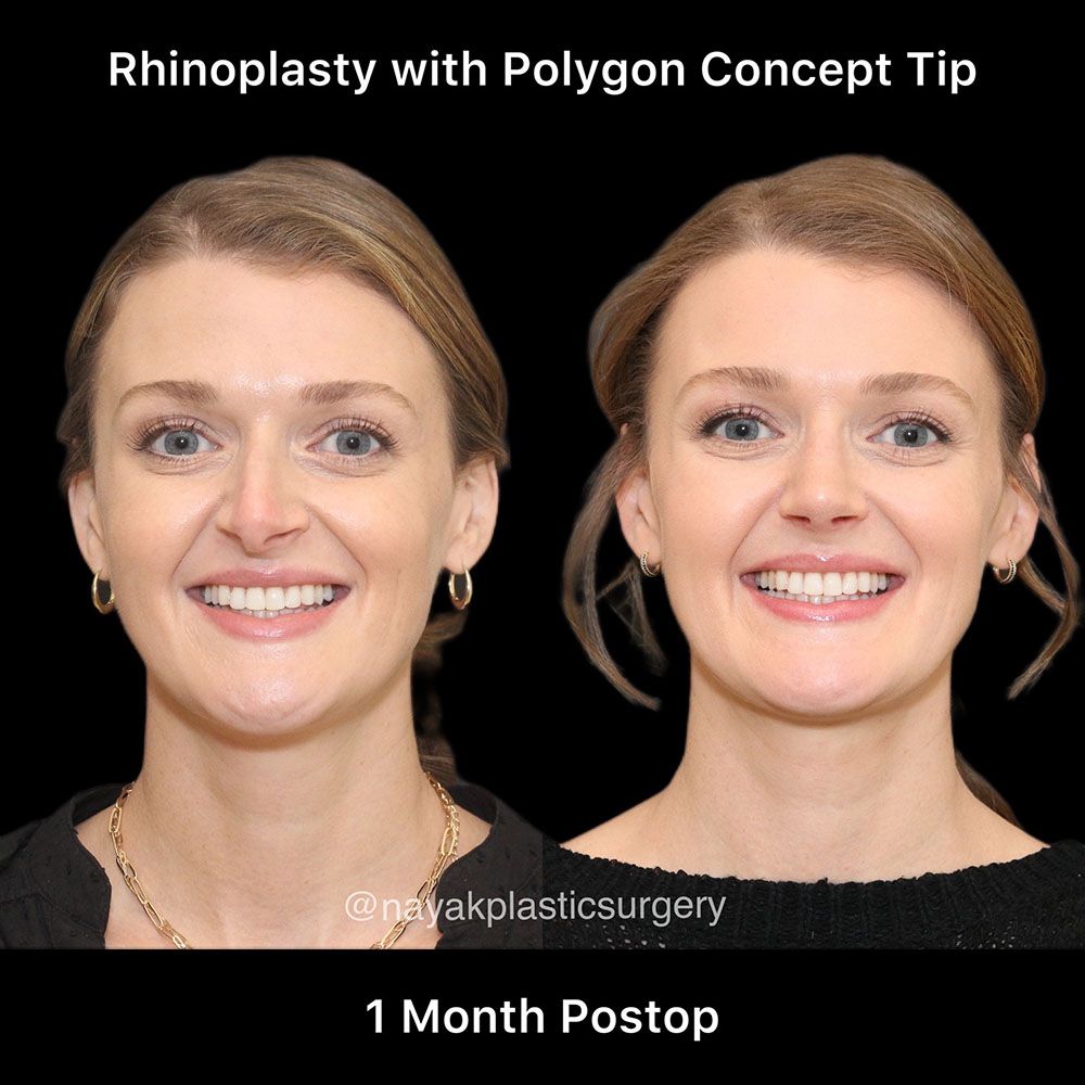 Rhinoplasty Before & After