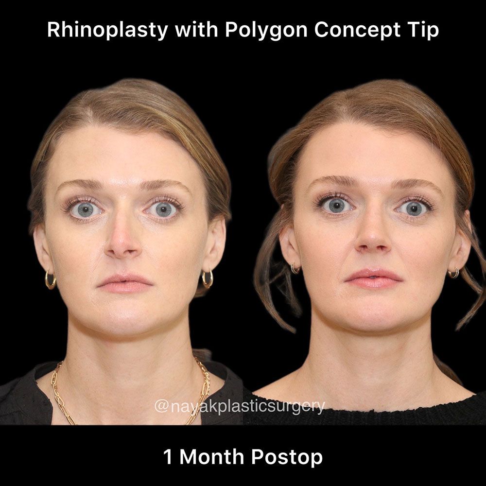Rhinoplasty Before & After