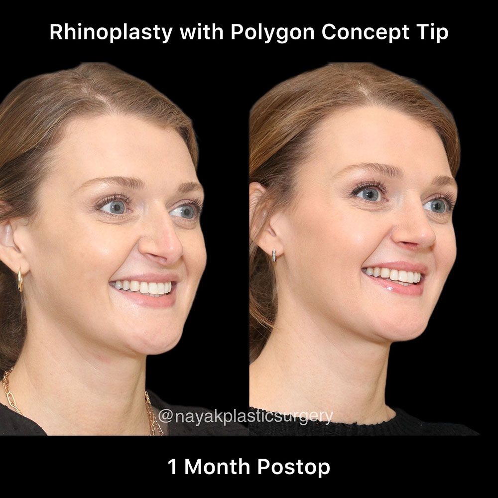 Rhinoplasty Before & After