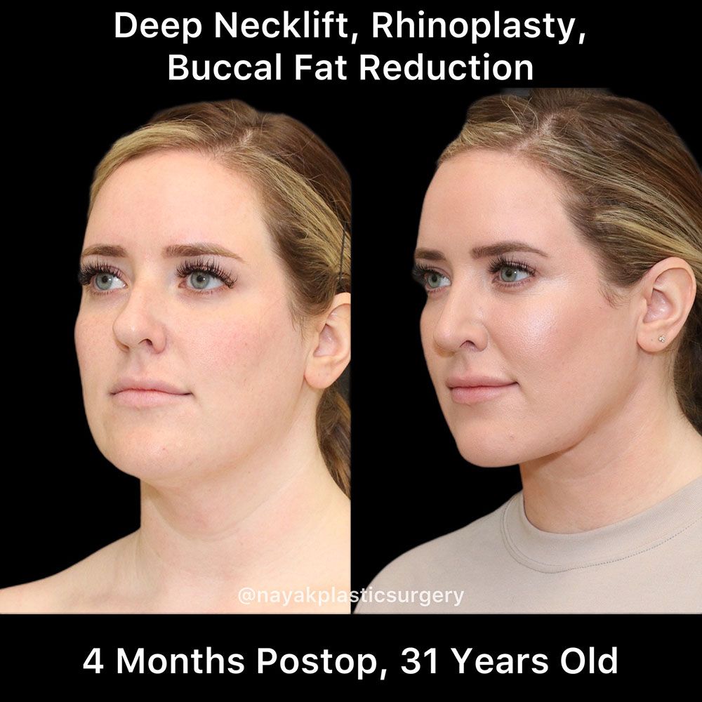 Rhinoplasty Before & After