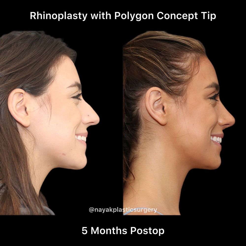 Rhinoplasty Before & After