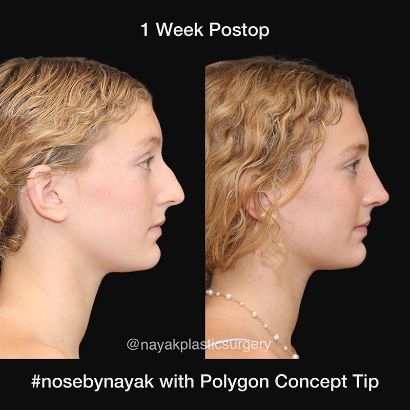 Rhinoplasty Before & After