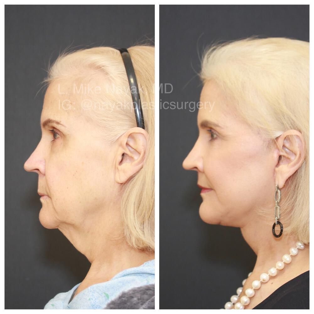 Blepharoplasty Before & After