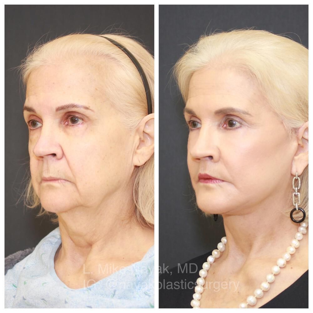 Blepharoplasty Before & After