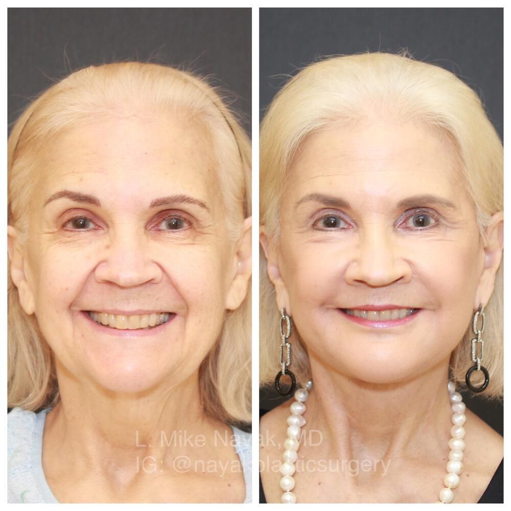 Blepharoplasty Before & After