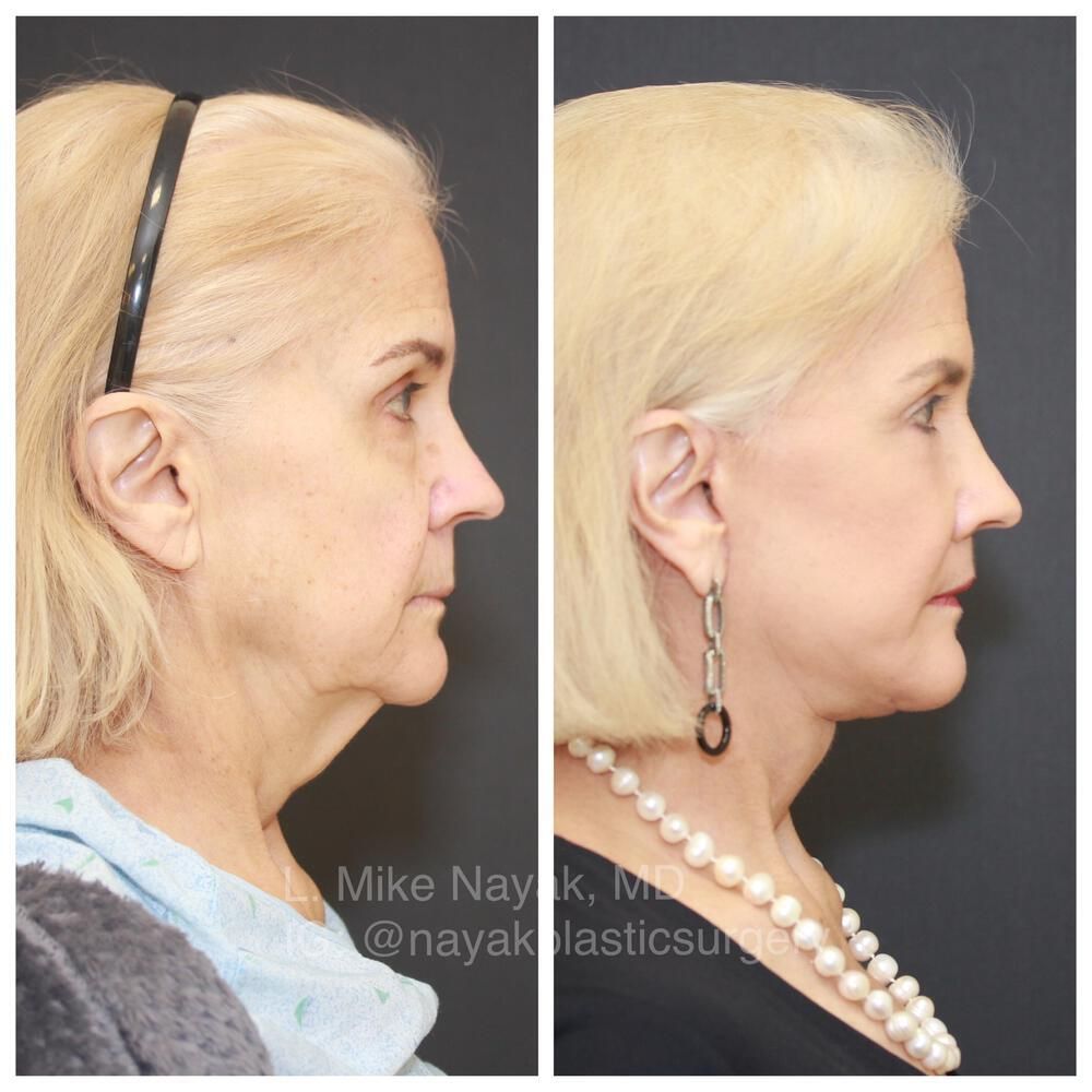 Blepharoplasty Before & After