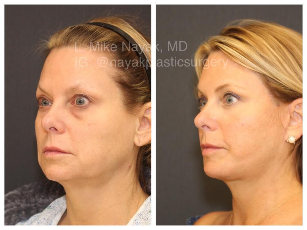 Blepharoplasty Before & After