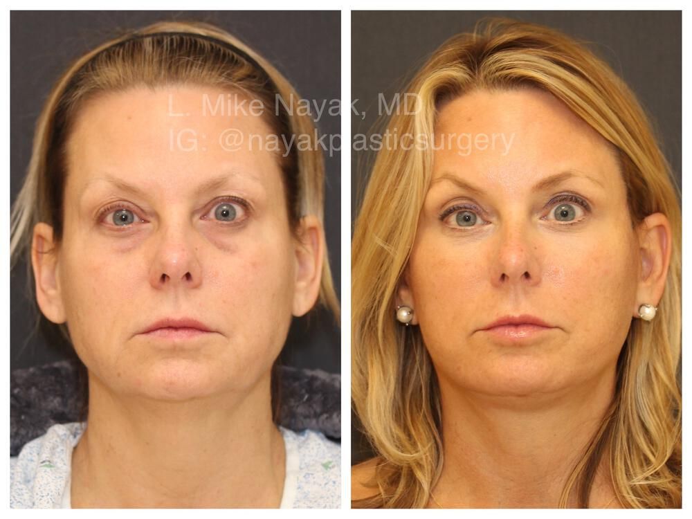 Blepharoplasty Before & After