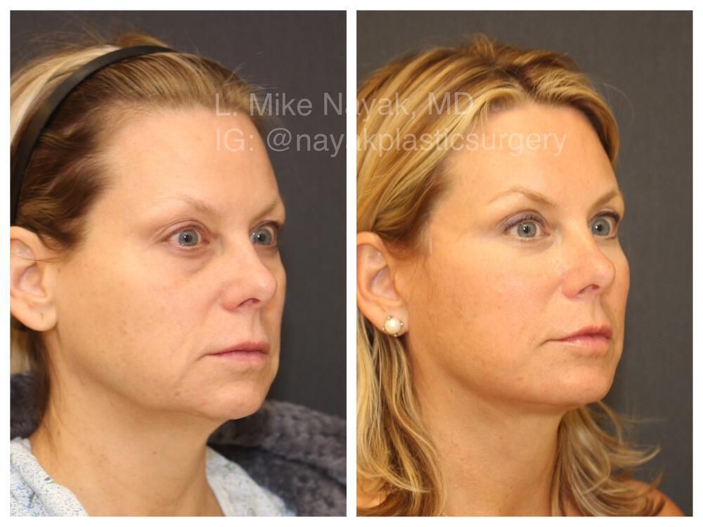 Blepharoplasty Before & After