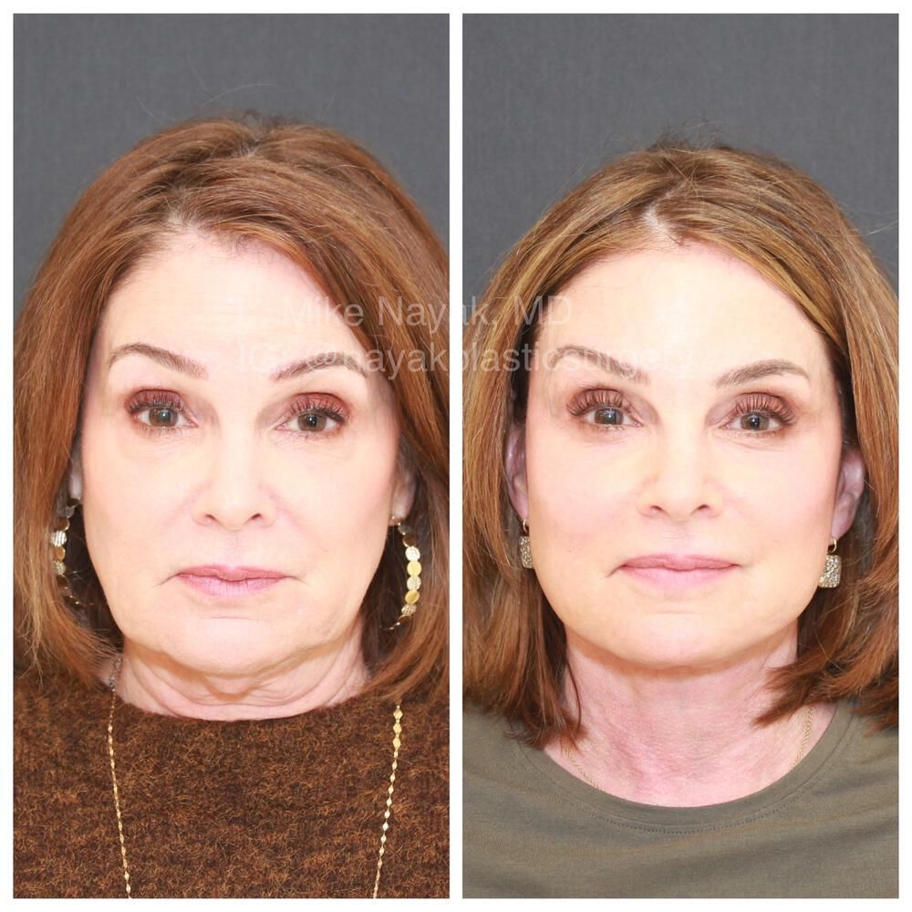 Blepharoplasty Before & After