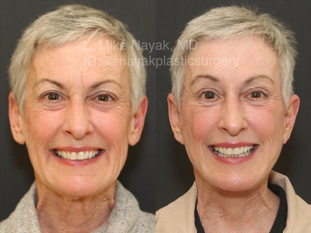 Blepharoplasty Before & After