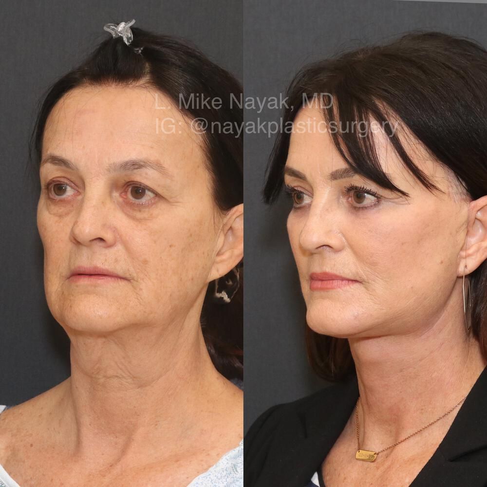 Blepharoplasty Before & After